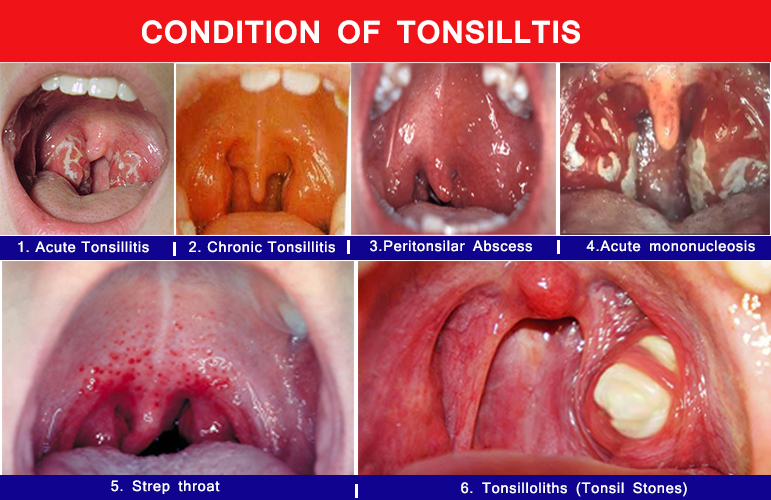 what is the best way to treat tonsil stones